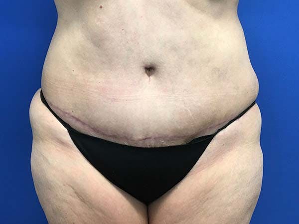 Tummy Tuck (Abdominoplasty) Gallery - Patient 121562692 - Image 2