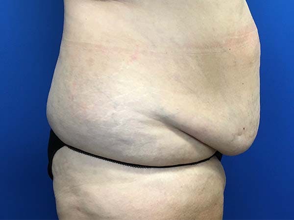 Tummy Tuck (Abdominoplasty) Gallery - Patient 121562692 - Image 3