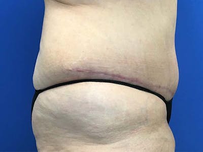 Tummy Tuck (Abdominoplasty) Before & After Gallery - Patient 121562692 - Image 4