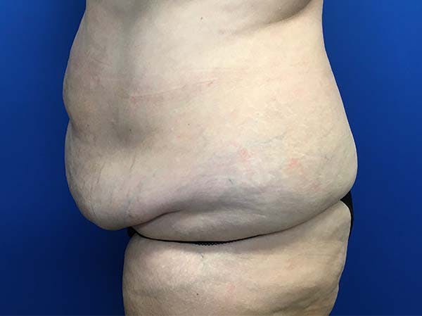 Tummy Tuck (Abdominoplasty) Gallery - Patient 121562692 - Image 5