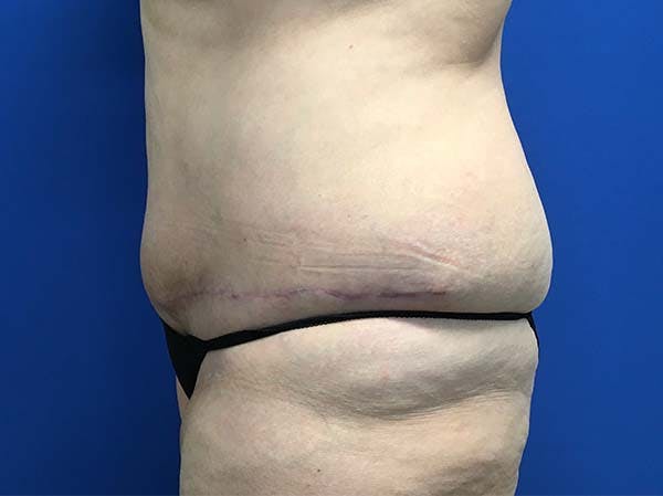 Tummy Tuck (Abdominoplasty) Gallery - Patient 121562692 - Image 6