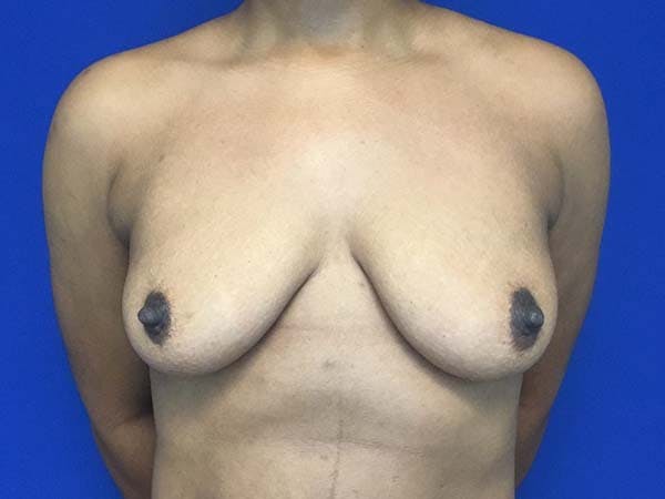 Mastopexy Before & After Gallery - Patient 121818247 - Image 1