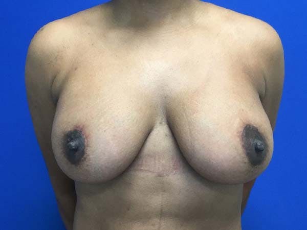 Breast Augmentation Before & After Gallery - Patient 121818233 - Image 2