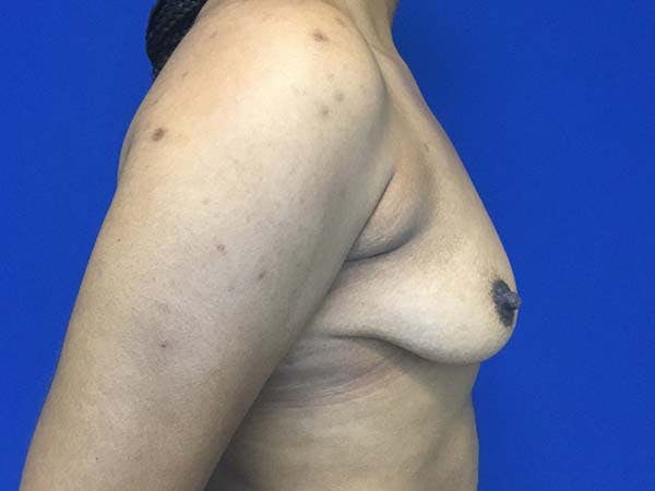 Mastopexy Before & After Gallery - Patient 121818247 - Image 3