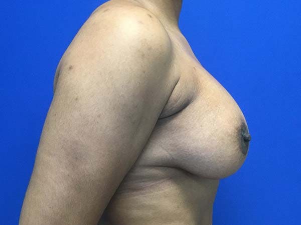 Mastopexy Before & After Gallery - Patient 121818247 - Image 4