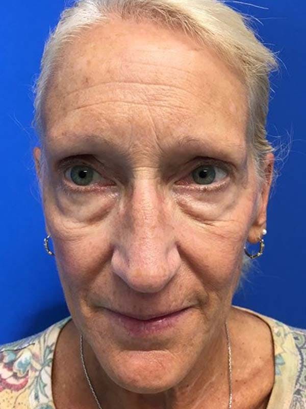 Face Lift Before & After Gallery - Patient 121959943 - Image 3
