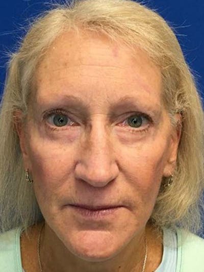 Face Lift Before & After Gallery - Patient 121959943 - Image 4