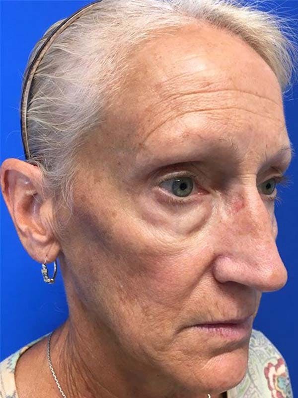 Neck Lift Before & After Gallery - Patient 121959947 - Image 3