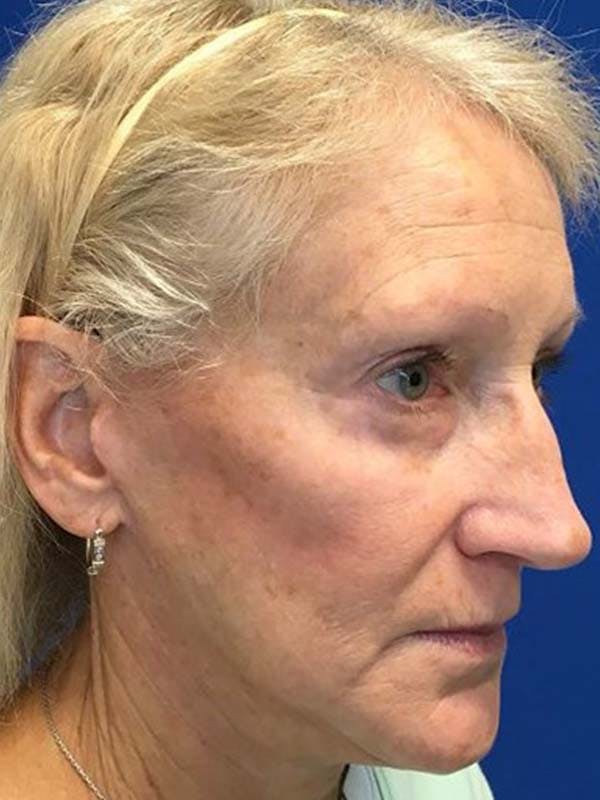 Face Lift Before & After Gallery - Patient 121959943 - Image 4