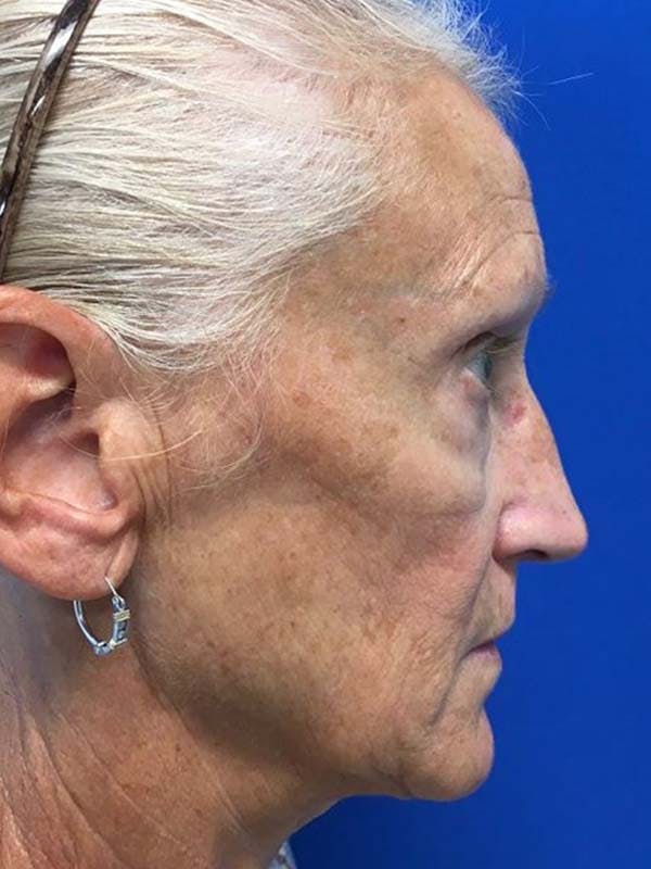 Neck Lift Before & After Gallery - Patient 121959947 - Image 5
