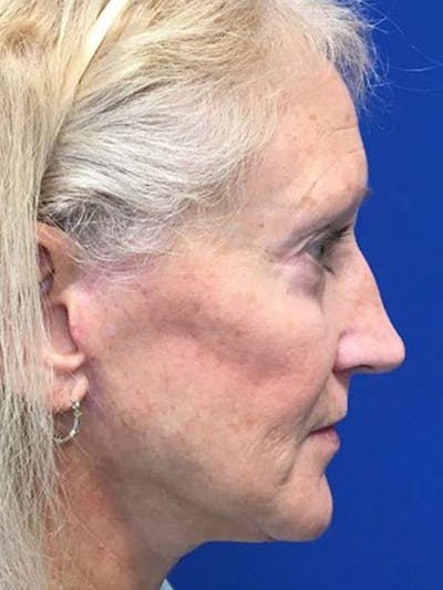 Neck Lift Before & After Gallery - Patient 121959947 - Image 6