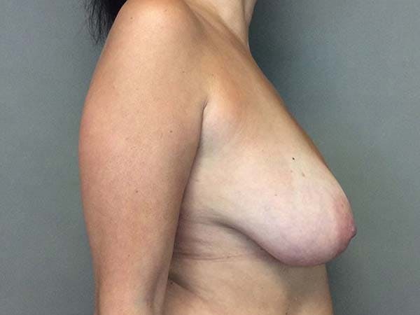 Mommy Makeover Before & After Gallery - Patient 122290168 - Image 19