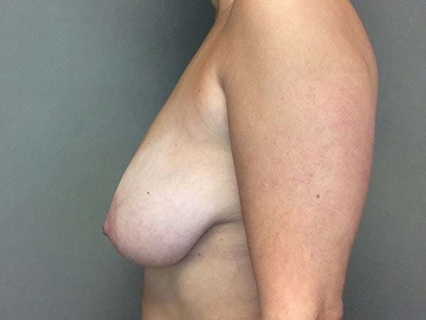 Mastopexy Before & After Gallery - Patient 122290013 - Image 7