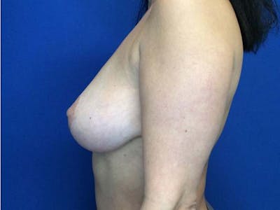 Mastopexy Before & After Gallery - Patient 122290013 - Image 8