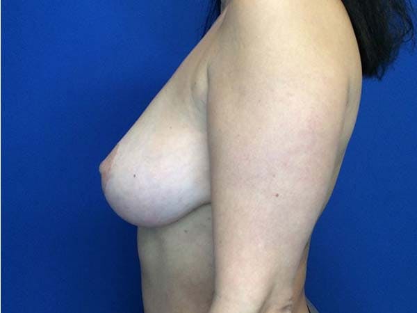 Mastopexy Before & After Gallery - Patient 122290013 - Image 8