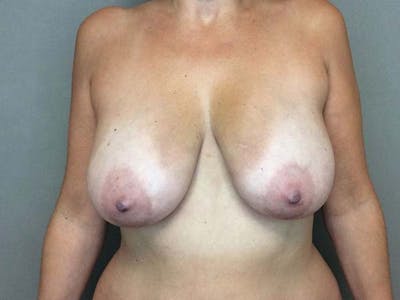 Mastopexy Before & After Gallery - Patient 122290013 - Image 1