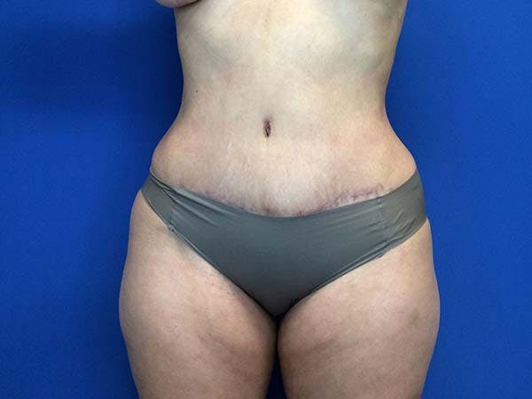 Tummy Tuck (Abdominoplasty) Gallery - Patient 122290148 - Image 2