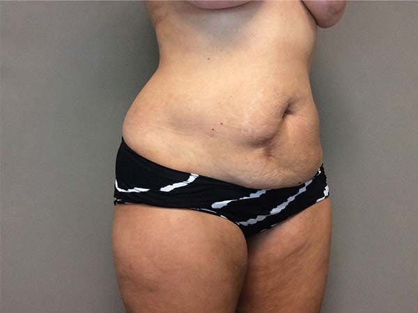 Tummy Tuck (Abdominoplasty) Before & After Gallery - Patient 122290148 - Image 3