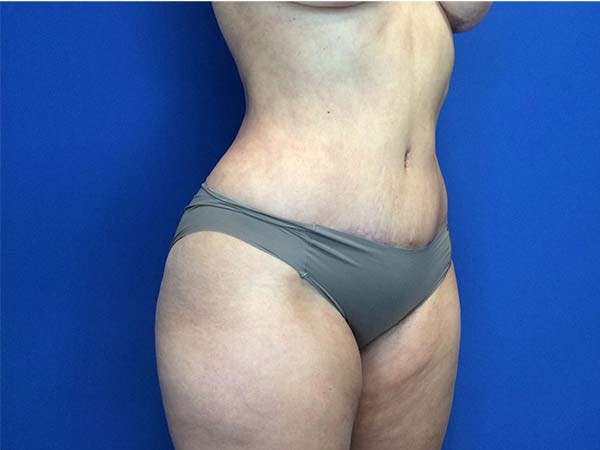 Liposuction Before & After Gallery - Patient 122290145 - Image 4