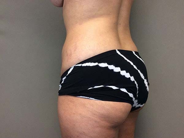 Tummy Tuck (Abdominoplasty) Before & After Gallery - Patient 122290148 - Image 5