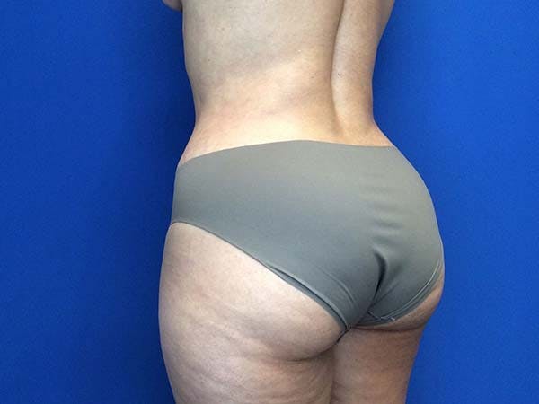 Tummy Tuck (Abdominoplasty) Before & After Gallery - Patient 122290148 - Image 6