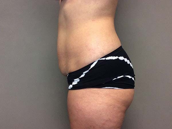 Liposuction Before & After Gallery - Patient 122290145 - Image 7