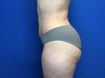 Liposuction Before & After Gallery - Patient 122290145 - Image 8