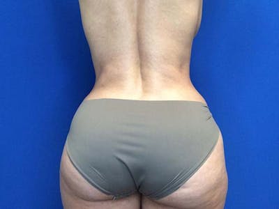 Tummy Tuck (Abdominoplasty) Before & After Gallery - Patient 122290148 - Image 10