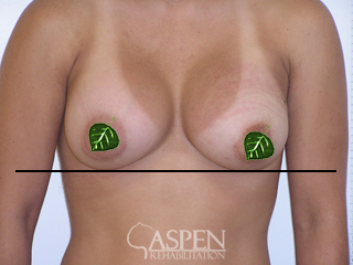 After breast augmentation photo