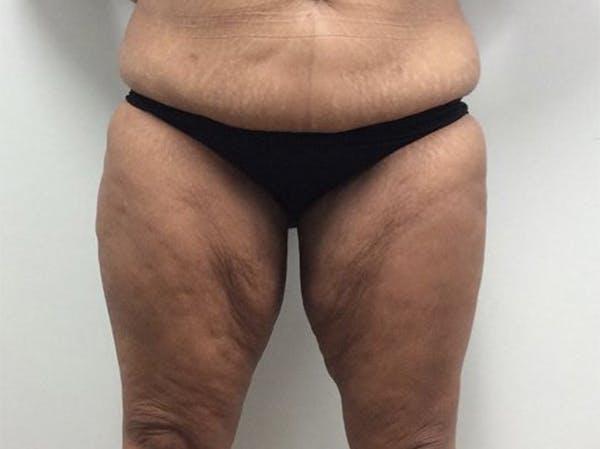 Thigh Lift