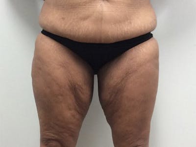 Thigh Lift Before & After Gallery - Patient 122621541 - Image 1