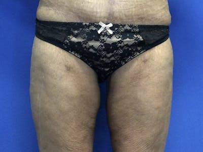 Thigh Lift Before & After Gallery - Patient 122621541 - Image 2