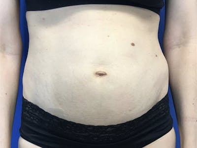Tummy Tuck (Abdominoplasty) Before & After Gallery - Patient 122623010 - Image 1