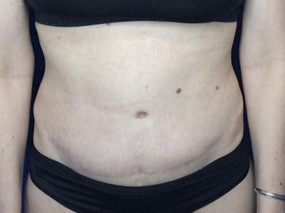 Liposuction Gallery - Patient 122623012 - Image 2