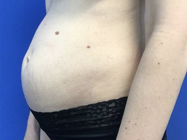 Tummy Tuck (Abdominoplasty) Before & After Gallery - Patient 122623010 - Image 3