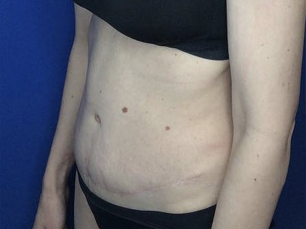 Liposuction Before & After Gallery - Patient 122623012 - Image 4