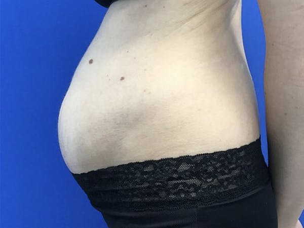 Tummy Tuck (Abdominoplasty) Before & After Gallery - Patient 122623010 - Image 5