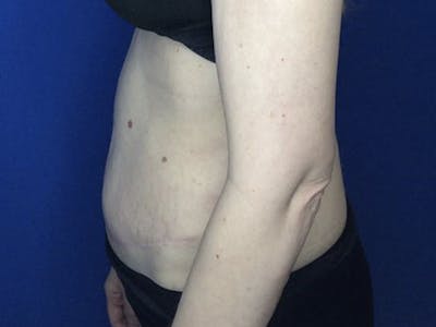 Liposuction Gallery - Patient 122623012 - Image 6