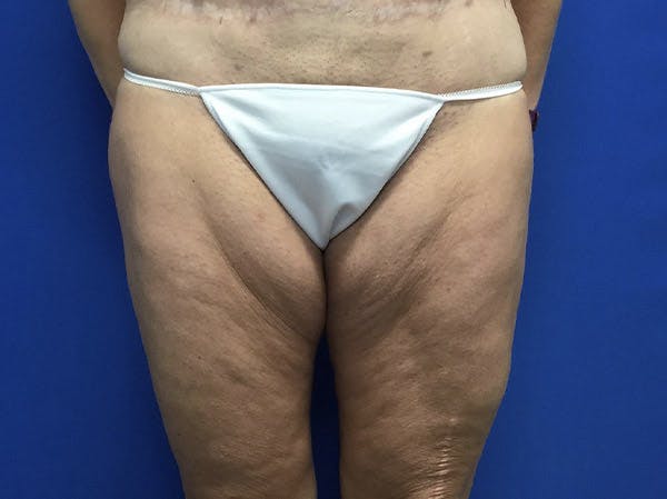 Thigh Lift Gallery - Patient 122655342 - Image 1