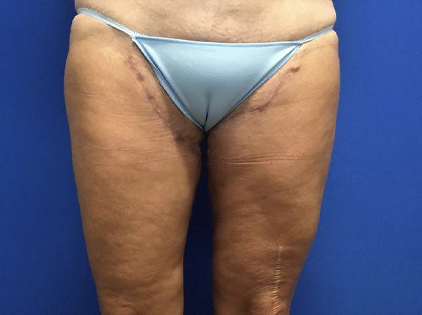 Thigh Lift Before & After Gallery - Patient 122655342 - Image 2