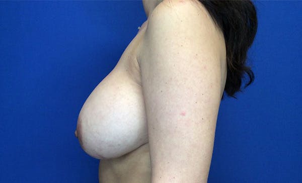 Mastopexy Before & After Gallery - Patient 122932566 - Image 5