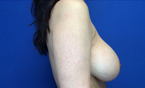 Breast Implant Removal and Replacement Before & After Gallery - Patient 122932562 - Image 7