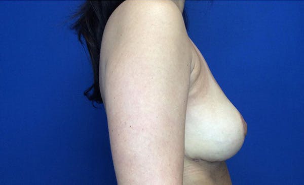 Breast Implant Removal and Replacement Before & After Gallery - Patient 122932562 - Image 8