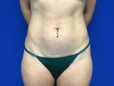 Liposuction Before & After Gallery - Patient 122947687 - Image 1