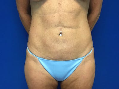 Liposuction Before & After Gallery - Patient 122947687 - Image 2