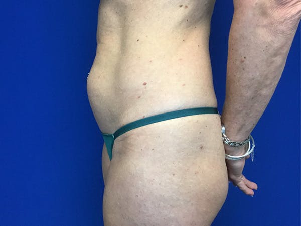 Liposuction Before & After Gallery - Patient 122947687 - Image 3