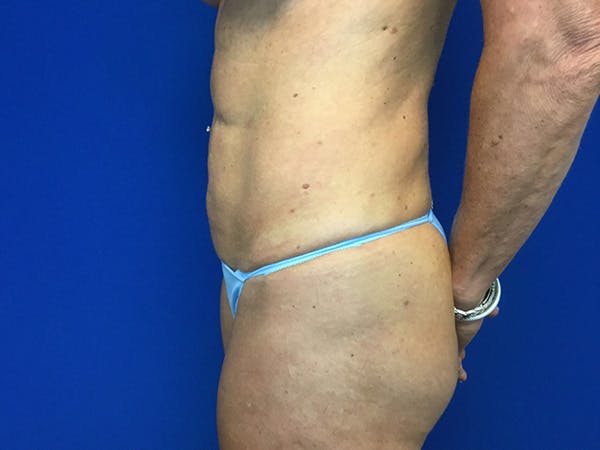 Liposuction Before & After Gallery - Patient 122947687 - Image 4