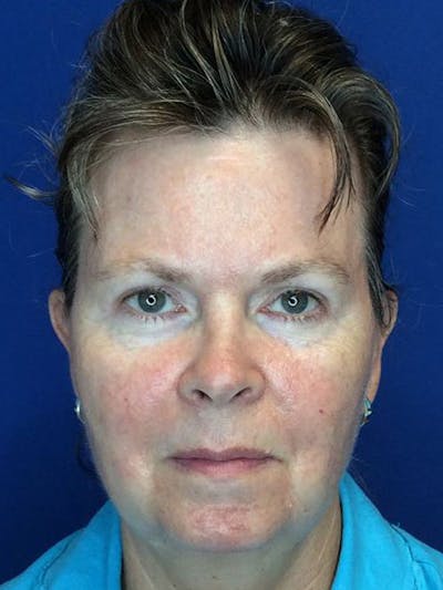 Brow Lift Before & After Gallery - Patient 123995205 - Image 2