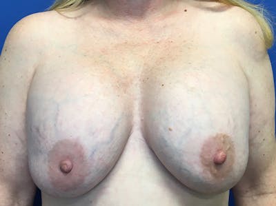 Breast Implant Removal and Replacement Before & After Gallery - Patient 140609768 - Image 1