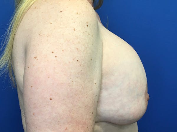 Breast Implant Removal and Replacement Before & After Gallery - Patient 140609768 - Image 3
